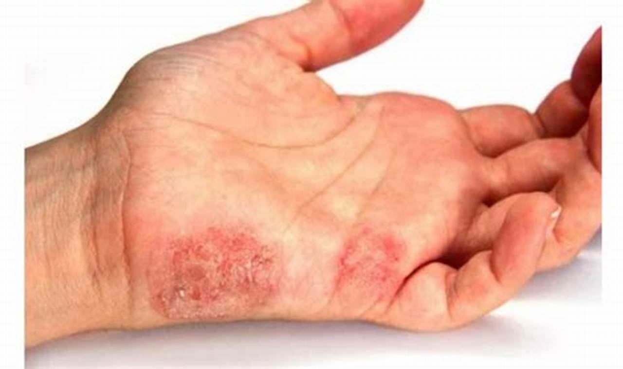Cara Mengatasi Kutu Air Di Tangan